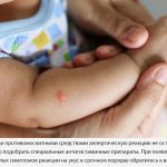 Mosquito bite in a child